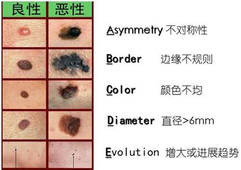 好痣顏色|這是痣，還是黑色素癌？